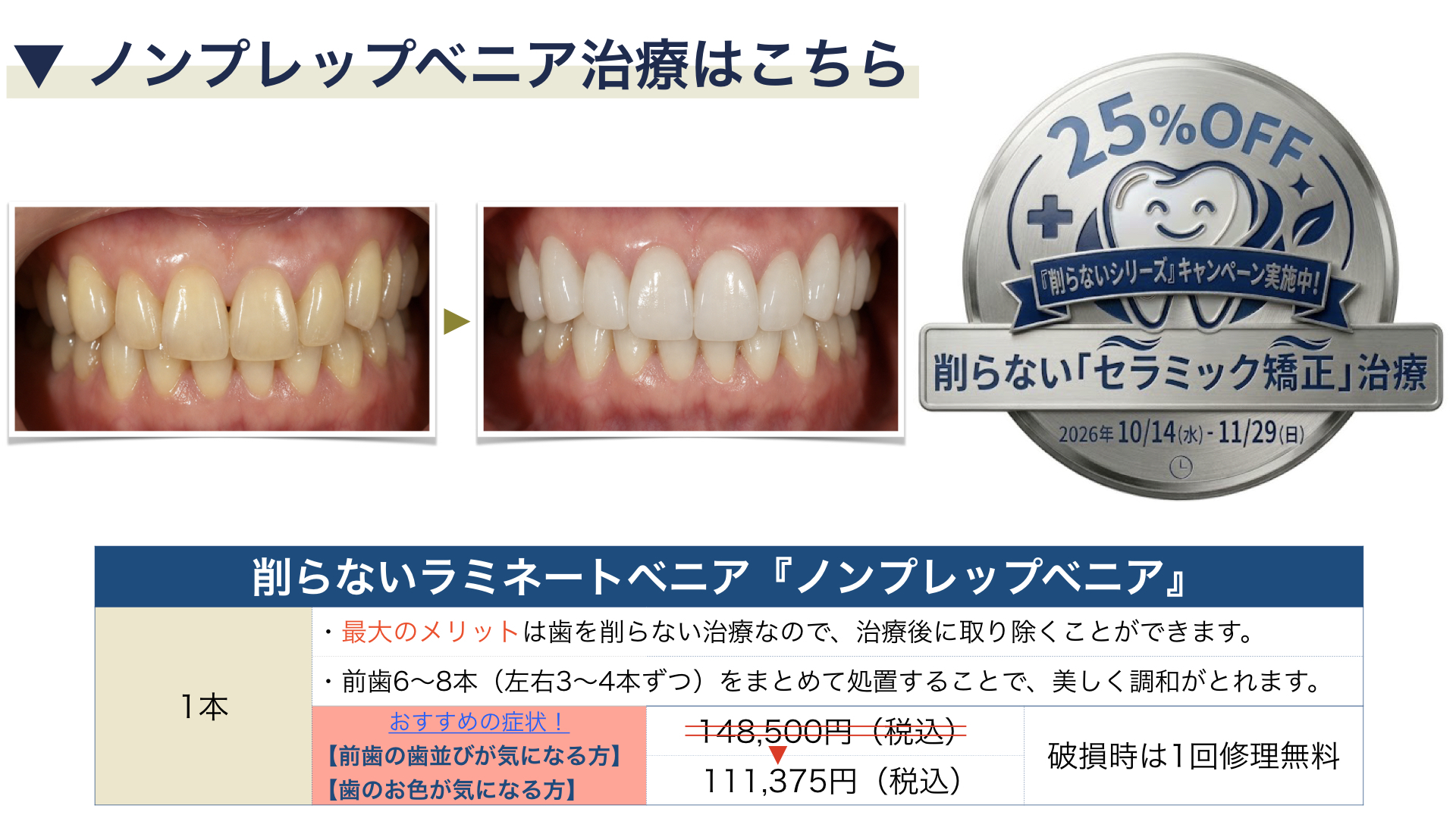 ノンプレップベニア